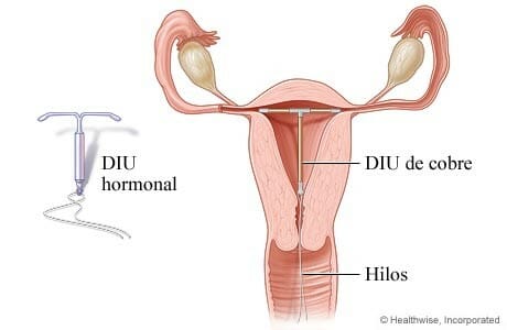 QUE ES UN DISPOSITIVO INTRAUTERINO