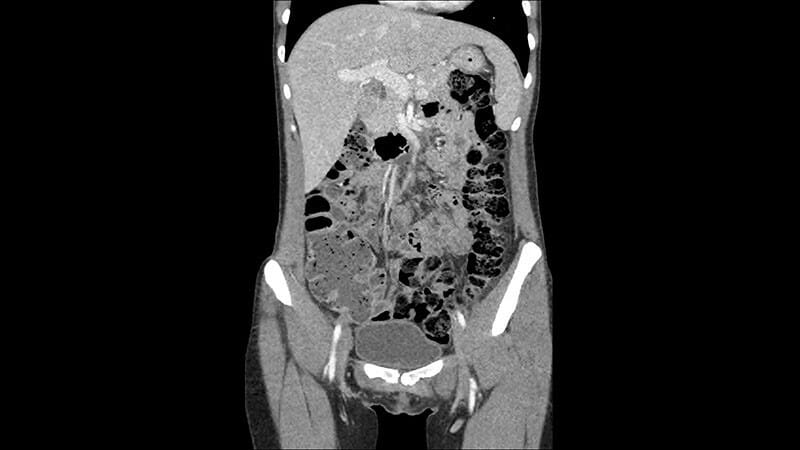 Que es la tomografia computarizada o CAT abdominal y pelvica