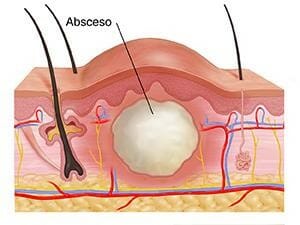 imagen absceso